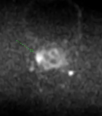 Diffusion MRI view of target prostate lesion 1