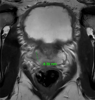 T2-weighted MRI view of target prostate lesion 1